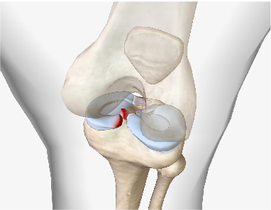 Robotic Partial Knee Replacement : A Brief Introduction