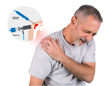 What is Shoulder Arthroscopy?