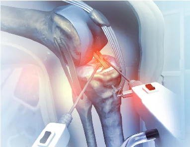 Robotic Vs. Traditional Knee Replacement Surgery