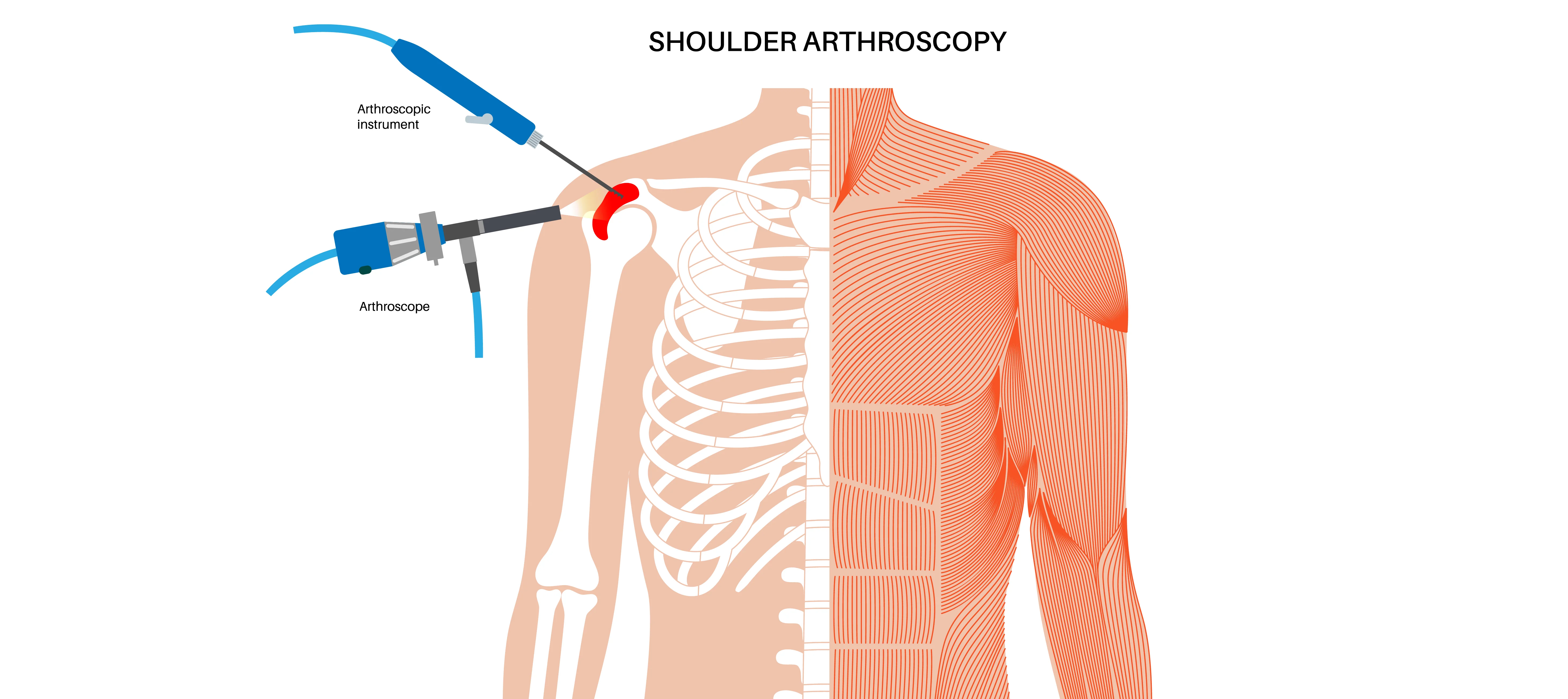 Essential Insights On Shoulder Arthroscopy: What You Need to Know