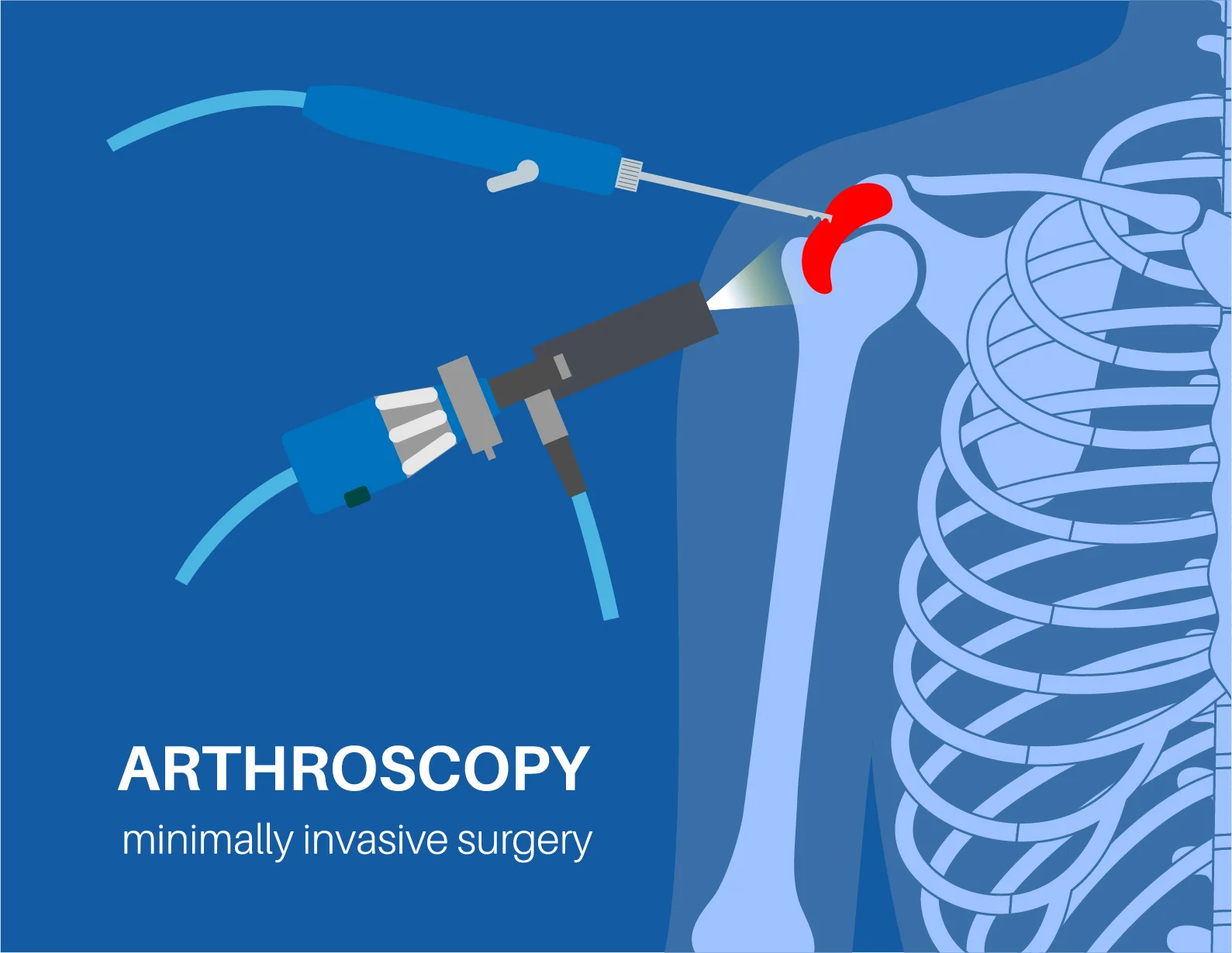 Everything You Should Know About Shoulder Arthroscopy