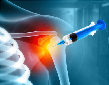 Shoulder Arthroscopy Recovery Time: What to Expect and How Long It Takes