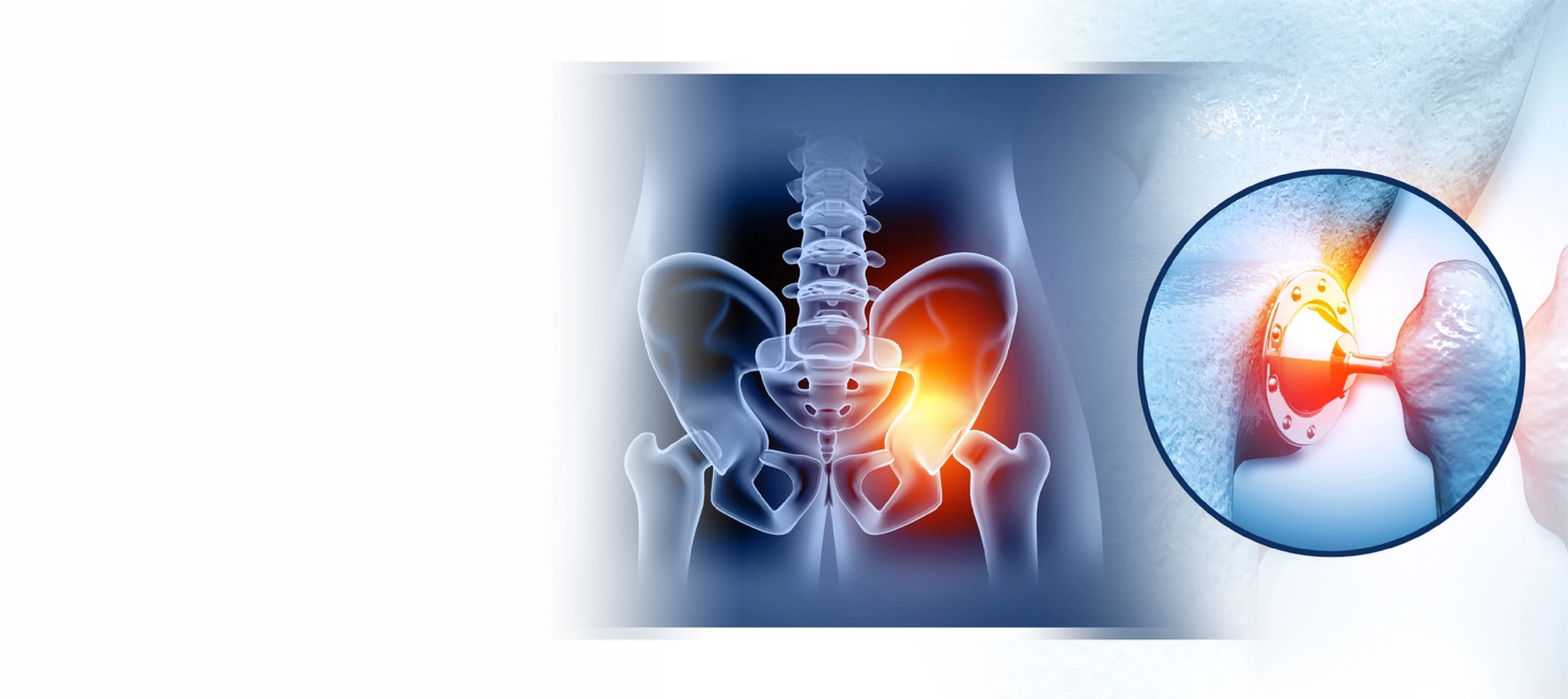 Which Hip Replacement Method Is Right For You? Exploring The Options