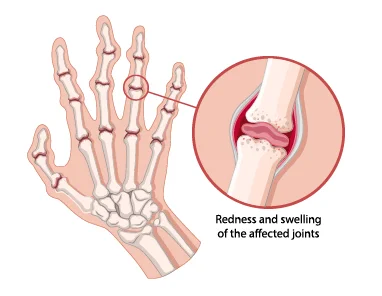 What Is Osteoarthritis? Symptoms, Diagnosis, And Treatment Options