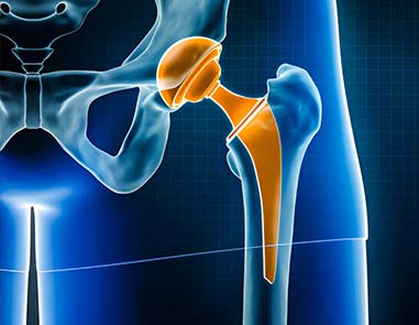 How To Choose The Best Hip Replacement Doctor In Delhi: A Complete Guide