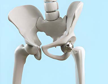 What To Expect During Total Hip Replacement Surgery In Delhi