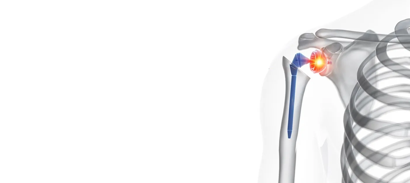Best Shoulder Replacement Surgeon in Dwarka | Expert Orthopedic Care