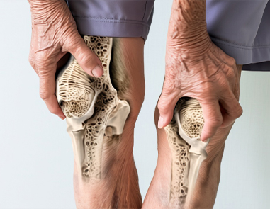 Preventing Osteoporosis: Protect Your Bones After Menopause