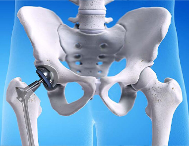 Best Hip Replacement Surgeon in Delhi for Advanced Joint Care