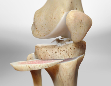 High Tibial Osteotomy: Procedure And Recovery