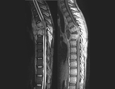 Spinal Tuberculosis: Symptoms and Treatment