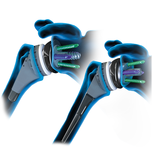shoulder replacement